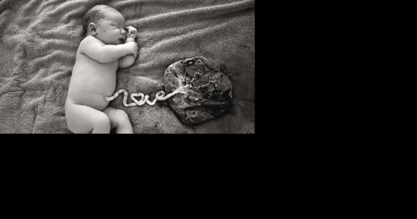 תמונת היום: תינוקת לאחר לידה מחוברת לשליה