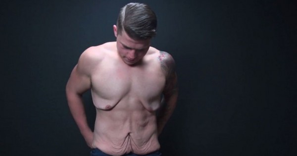 הבחור שגאה בעודפי העור שלו