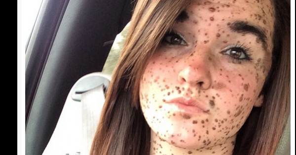 בת 19 סובלת מבריונות בגלל מחלת עור נדירה