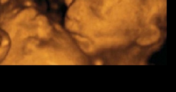 הסיפור הטראגי מאחורי תמונת האולטרסאונד של התאומים