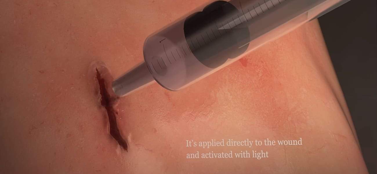 דבק 60 שניות: קבוצת מחקר יצרה דבק רקמות שמטפל בפצעים פנימיים