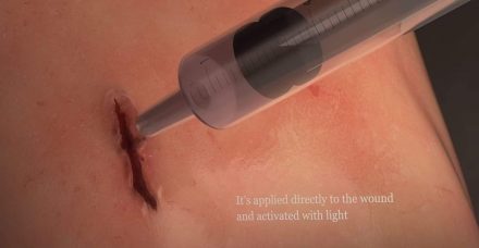 דבק 60 שניות: קבוצת מחקר יצרה דבק רקמות שמטפל בפצעים פנימיים