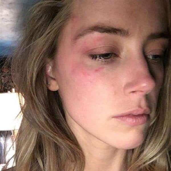 אמבר הרד חבולה