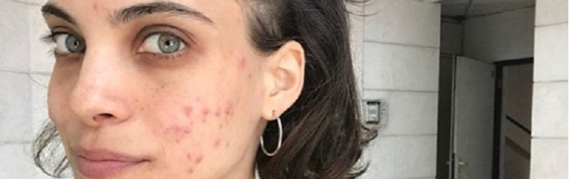 אחרי הצלוליט וסימני המתיחה, עכשיו הגיע הזמן לחבק גם את האקנה