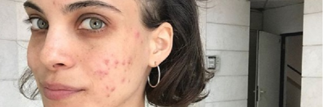 אחרי הצלוליט וסימני המתיחה, עכשיו הגיע הזמן לחבק גם את האקנה